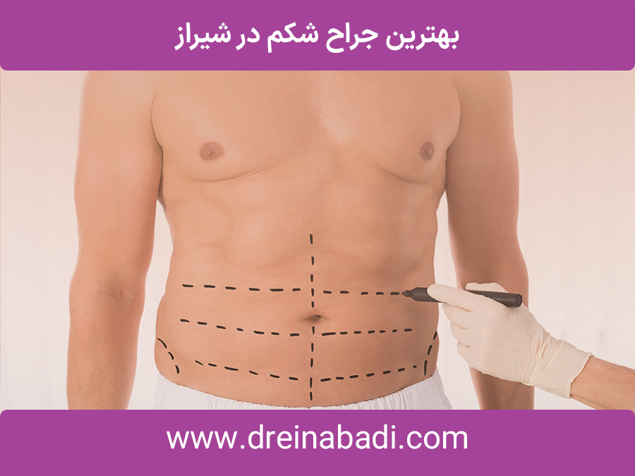 بهترینجراحشکمدرشیراز