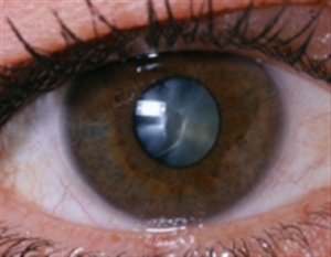 Aftercareofcataractsurgery
