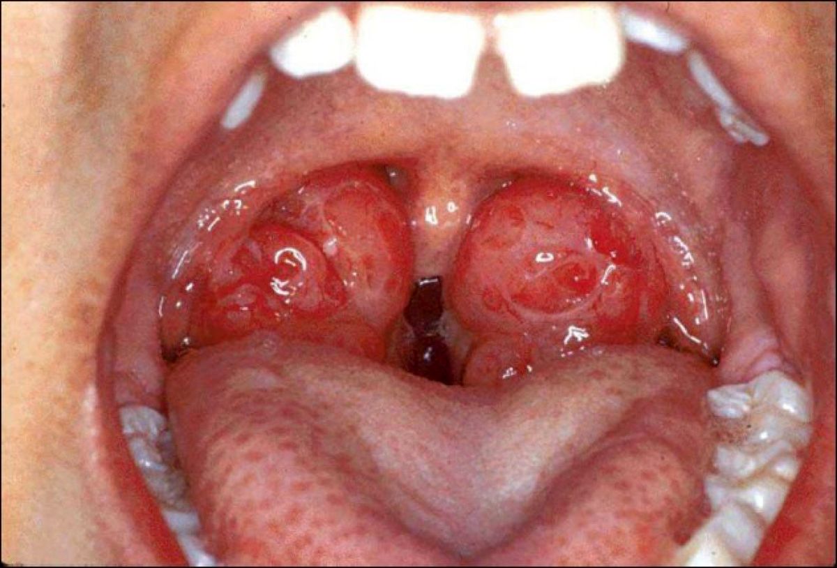 Tonsillectomy