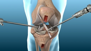 PostoperativecareofACLorACLrupture