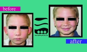 Otoplasty