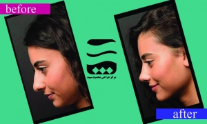 Rhinoplasty