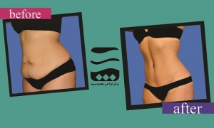 جراحةتجميلالبطن