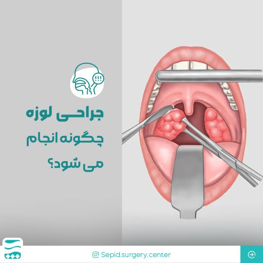 جراحیلوزهدرشیراز-مرکزتخصصیجراحیسپید