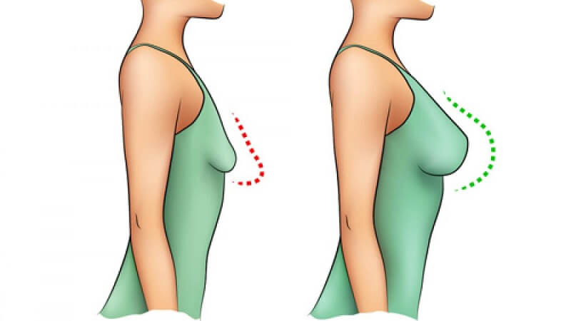 معایبومزایاییعملجراحیپروتزسینهبههمراهلیفت-مرکزجراحیسپید