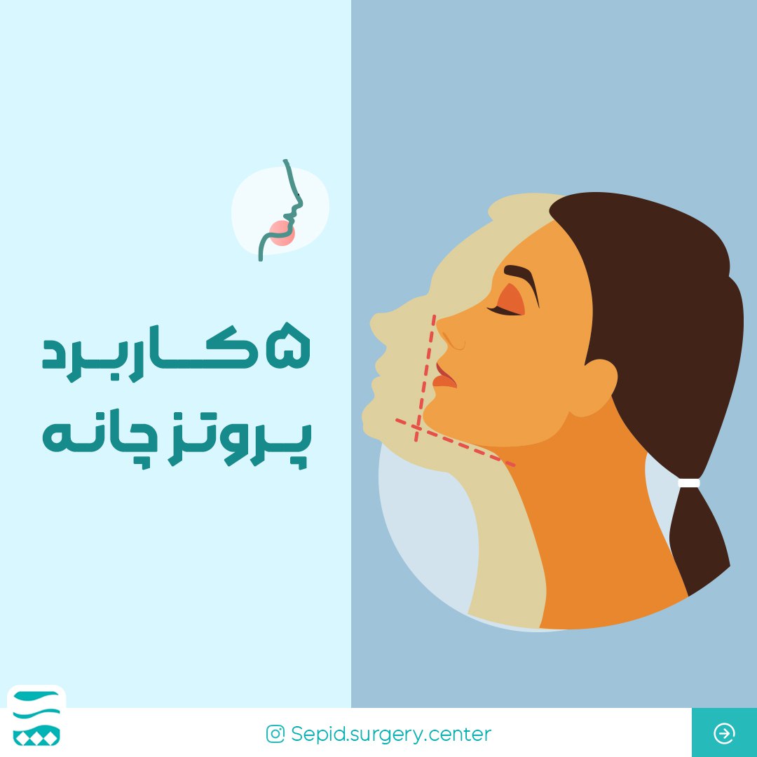 پنجکاربردپروتزچانه-مرکزتخصصیجراحیسپید-شیراز