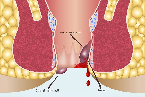 هموروئیدچیست؟