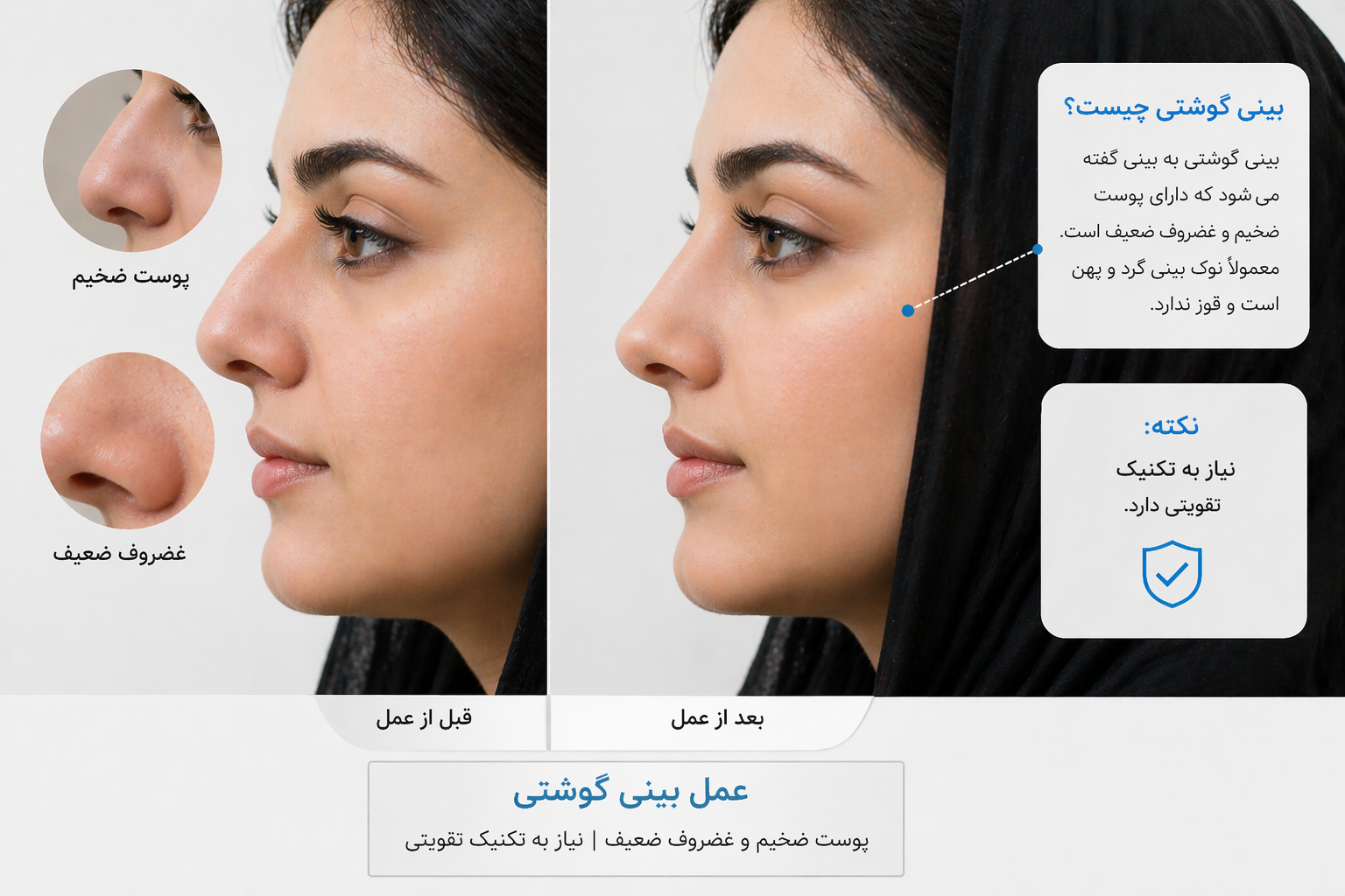بینیگوشتیچیست؟