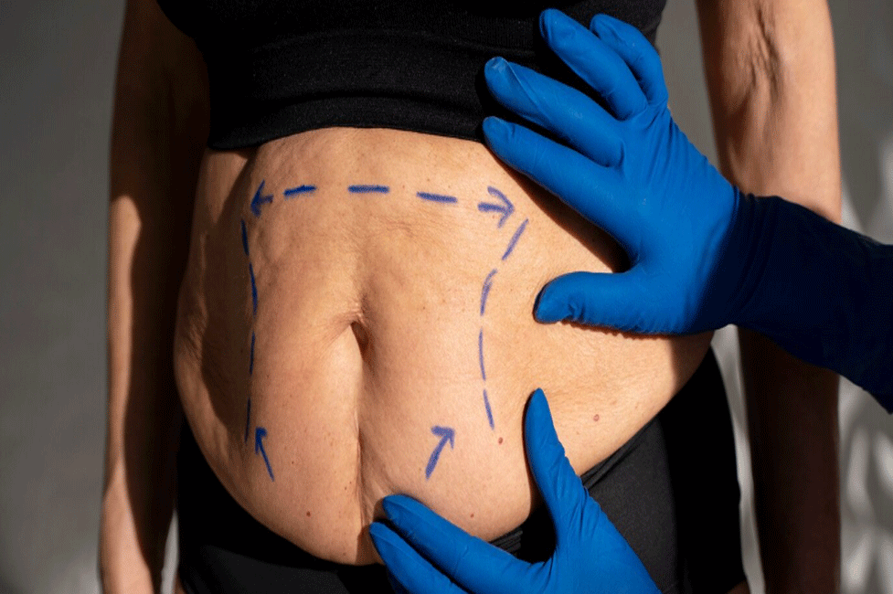 ابدومینوپلاستی