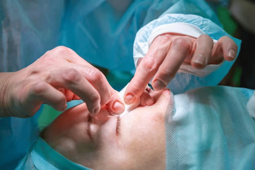 راینوپلاستی