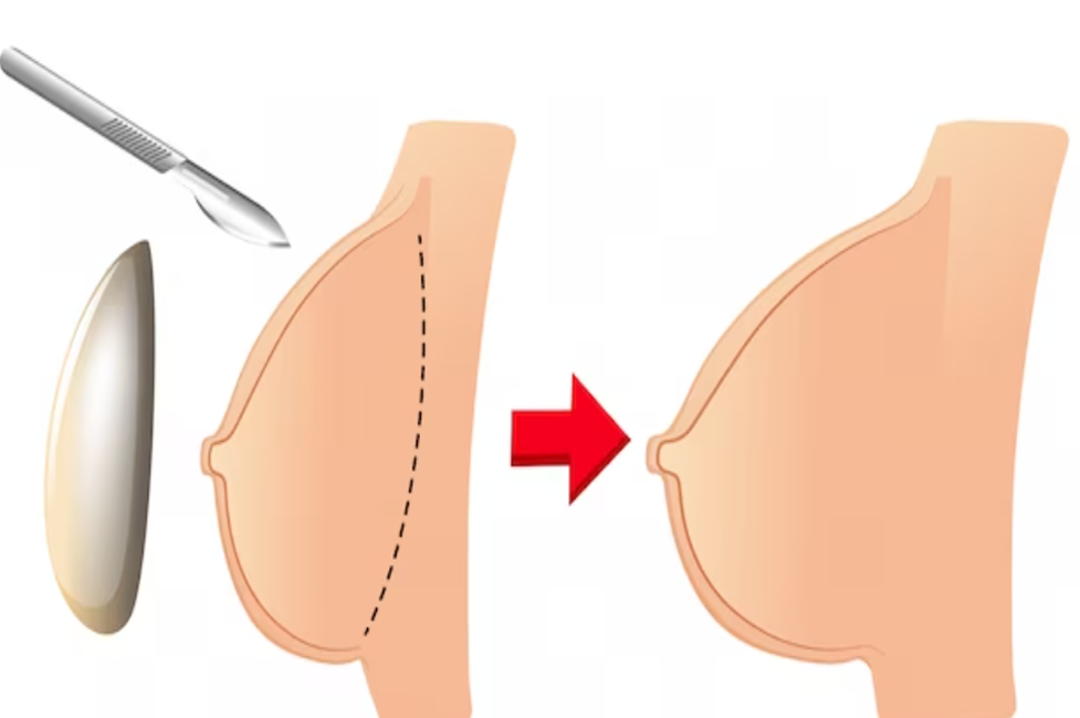 عملزیباییسینه(پروتزسینه)