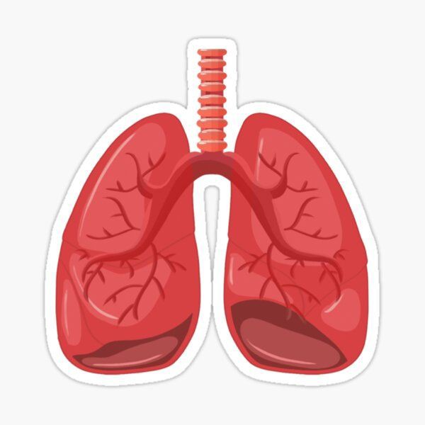 بیماریبرونشیت(bronchitis)